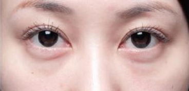 有什么土方法去眼袋好
