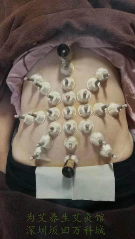 艾灸腹部的好处与功效
