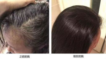 血热掉头发怎么办