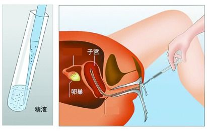 人工授精需要多少钱
