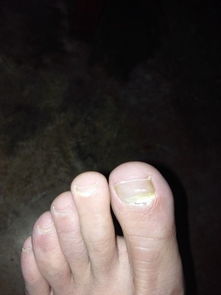 脚趾甲发白并脱落,,不痛不痒,大概在半年内发现,之前没有挤压等情况