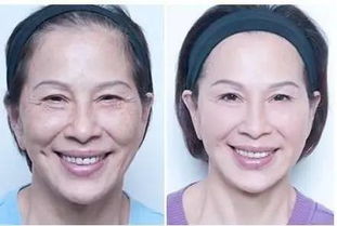 如何去除额头的皱纹?