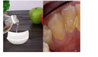 怎样去除牙结石小窍门
