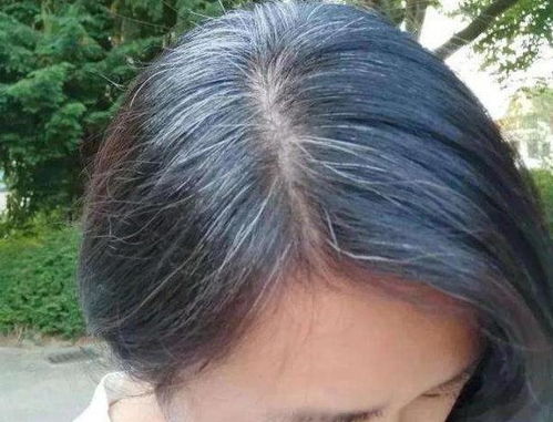 白头发缺乏什么维生素?