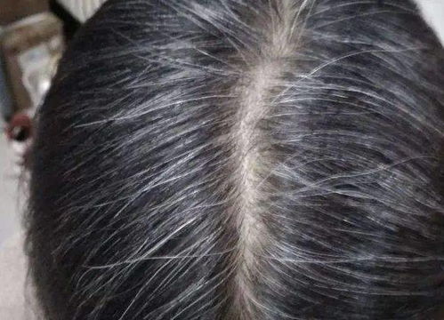 白头发是缺少什么微量元素
