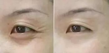 去鱼尾纹方法
