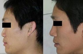 男生隆鼻
