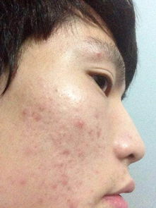 怎么才能让脸上的痘印消除，痘印怎么消除小妙招图片