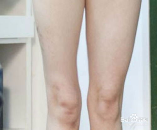 小腿肌肉萎缩平时怎么按摩?