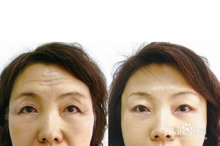 额头有抬头纹怎么办图片，经常抬头导致额头纹怎么消除