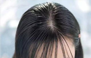 头皮出油严重脱发，头皮出油脱发怎样治疗