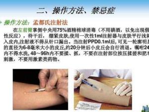 成人结核菌素试验怎么做，结核菌素试验怎么做有危害吗