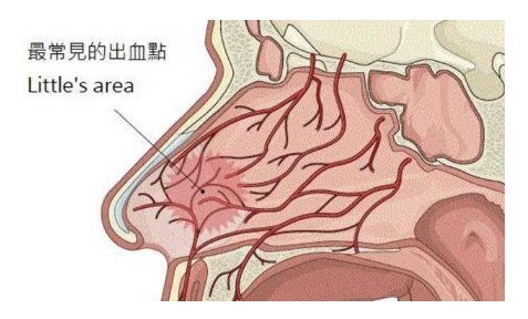 鼻血流不止是什么原因怎么治疗，鼻子流鼻血不止是什么原因