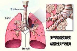 急性支气管炎传染吗，毛细支气管炎传染吗