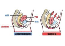 盆底肌检查怎么做疼吗，盆底肌评估怎么做