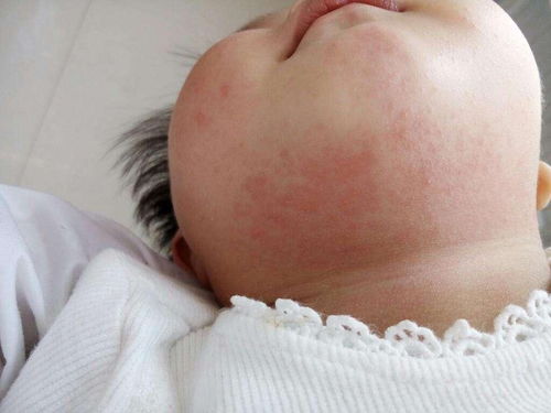 起痱子应该怎么办?