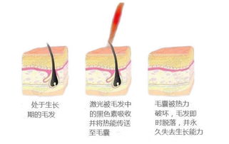 光子脱毛激光脱毛冰点脱毛，激光脱毛与光子脱毛的区别与问题