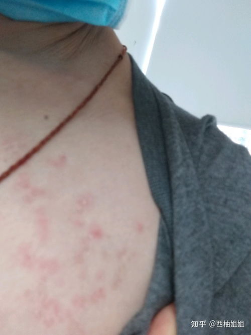 身上长痱子怎么办，宝宝冬天长痱子怎么办