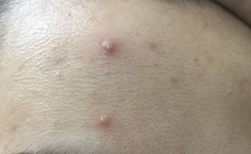 红肿脓包痘痘怎么办，红肿脓包型痘痘怎么处理