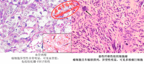 间叶组织来源的恶性肿瘤称为，间叶组织来源肿瘤