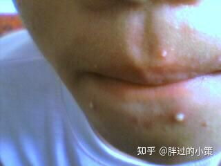 红肿化脓痘痘怎么办