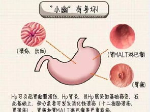 幽门螺杆菌正常值是多少