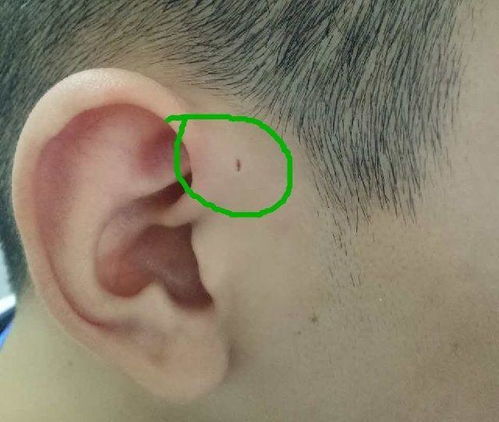 耳朵旁怎么写，耳朵旁边有痣