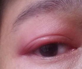 眼睛肿了是热敷还是冷敷好，眼睛肿痛