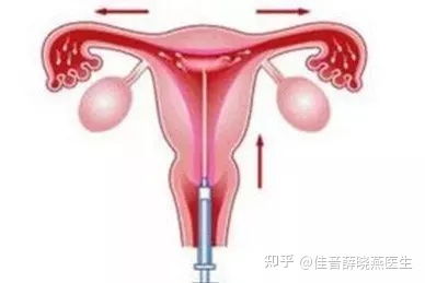 在家做人工授精图片，在家做人工授精怀孕小说