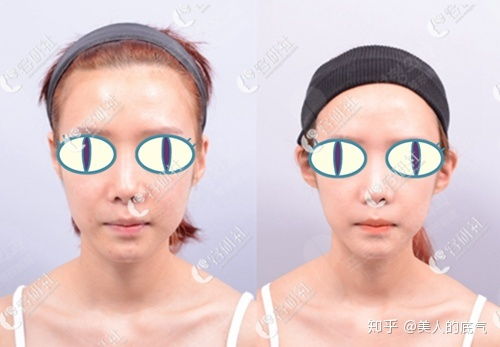 正面看不到耳朵怎么改善，明星正面都能看到耳朵