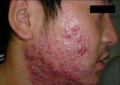 脓包痘痘是怎么引起的，脓包痘痘自己如何处理