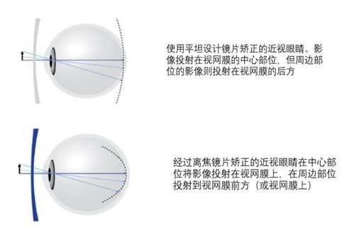 离焦镜片有几种