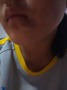脸上有淤青怎么快速消除小妙招，脸上的淤青怎么可以快速消除