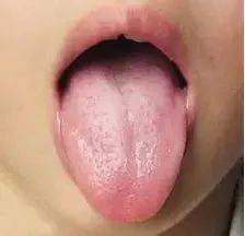 如何学会看舌苔