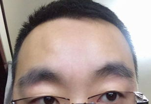 额头有细纹了该怎么办，额头有细纹怎么去除