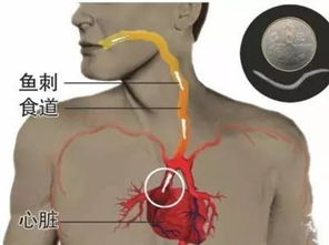 鱼刺卡住喉咙的9种解决办法