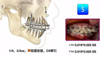 支抗英文，支抗的三种类型