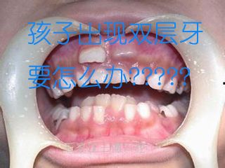 长重牙是什么原因?