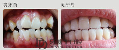 重牙拔牙多少钱一颗啊，重牙后注意些什么