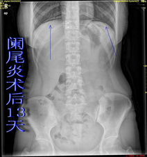 人工气腹的结构