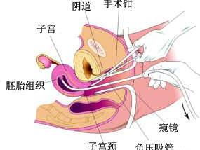 引产是什么意思,宝宝还能要吗?，住院引产是什么意思