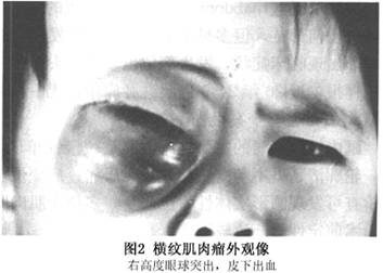 眼眶减压手术，眼眶骨折算几级伤残