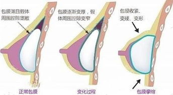 挛缩是什么意思