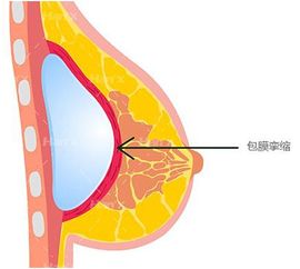 肌肉挛缩是什么意思，神经挛缩是什么意思