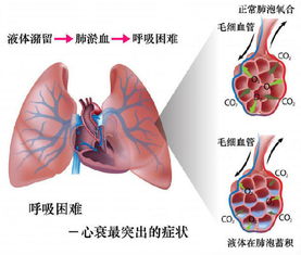 衰竭的意思解释一下，i型呼吸衰竭的意思