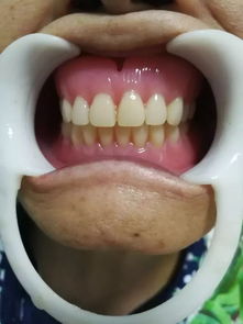 义齿是什么意思?