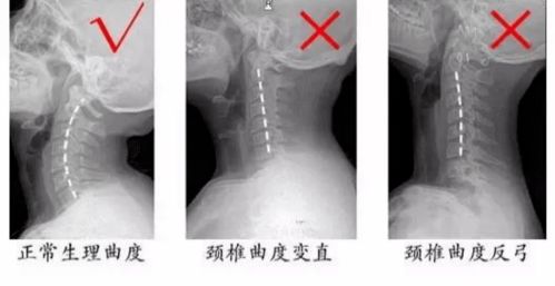 曲度牌腰椎治疗仪官网，曲度腰椎治疗仪有效吗