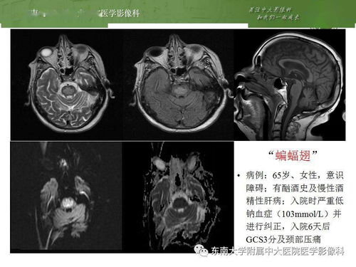 脑桥的作用，脑桥内的脑神经核有