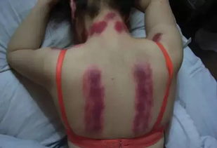 什么是痧?