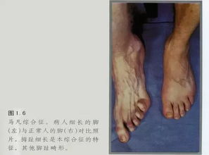 马凡氏综合症(婴儿患有马凡综合症的时候)